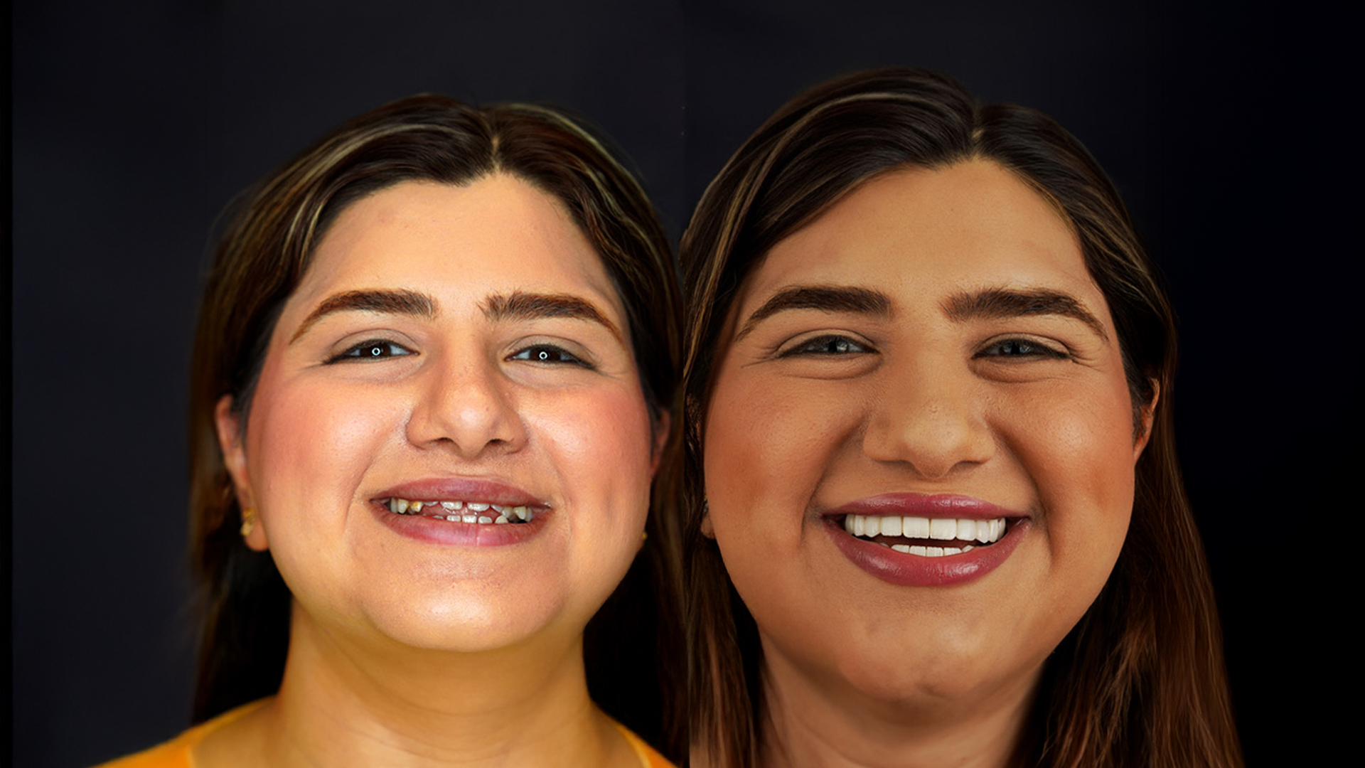 Hollywood Smile before and after