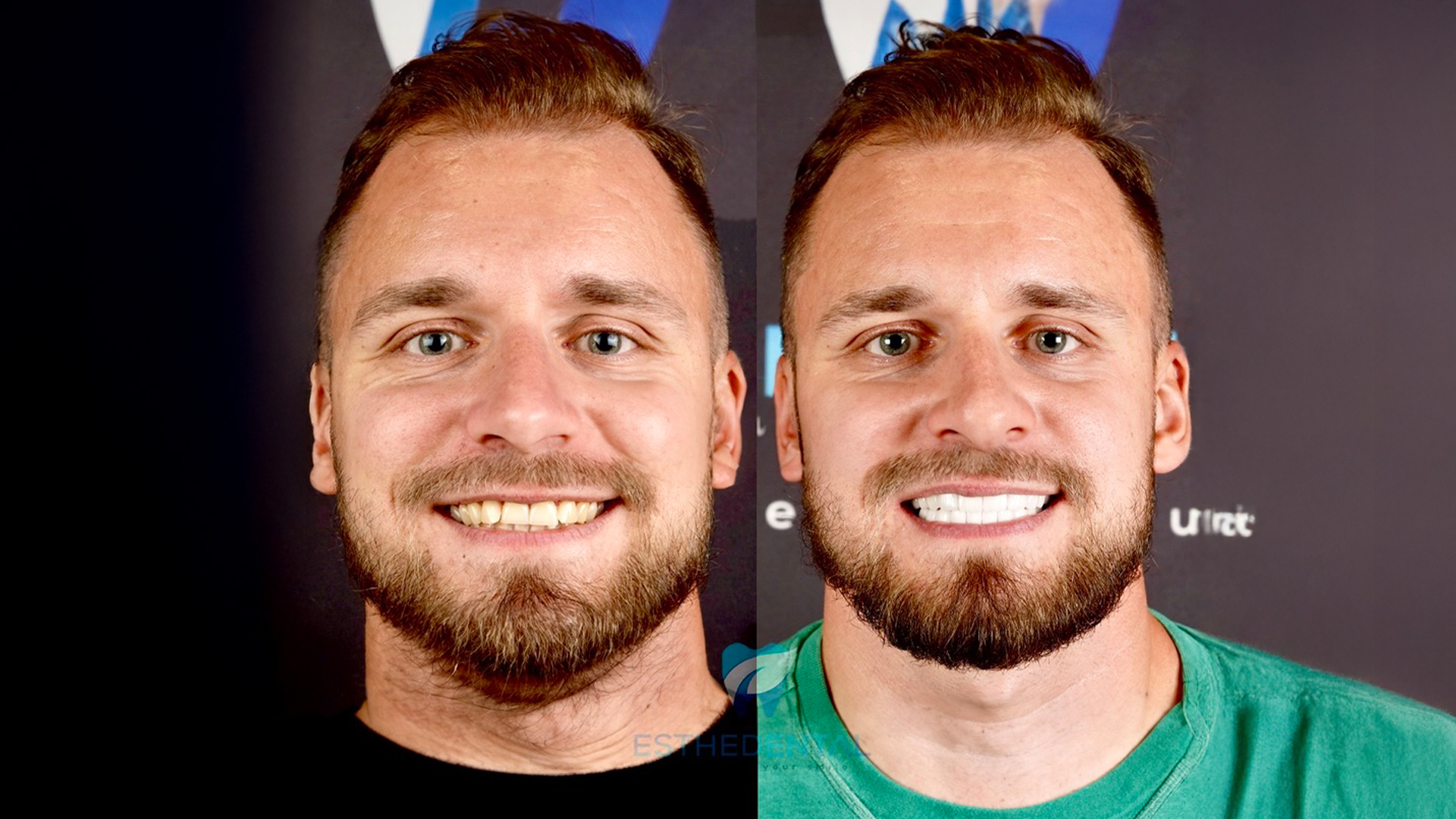 All-on-4 before and after
