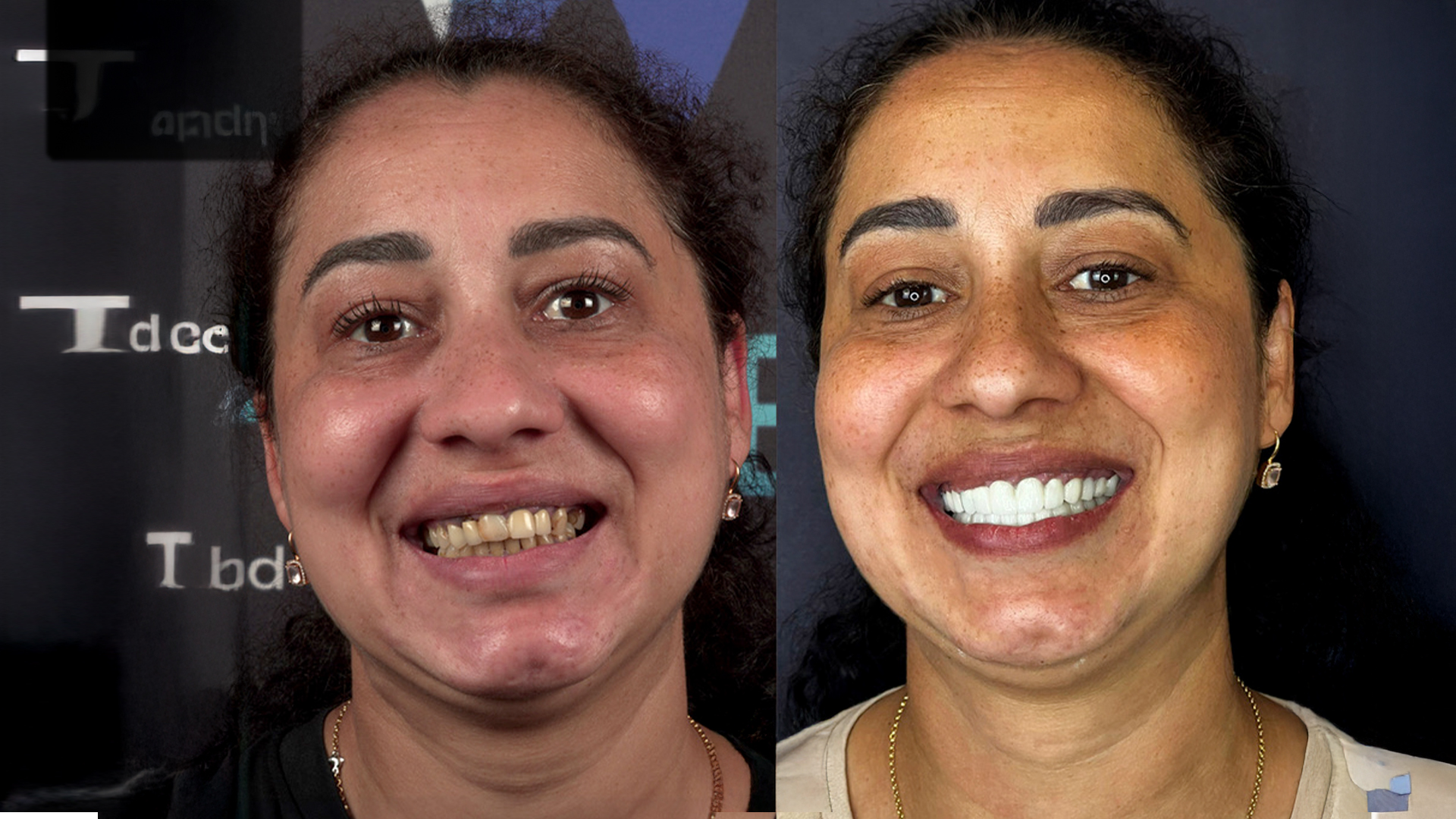 E-Max veneers before and after