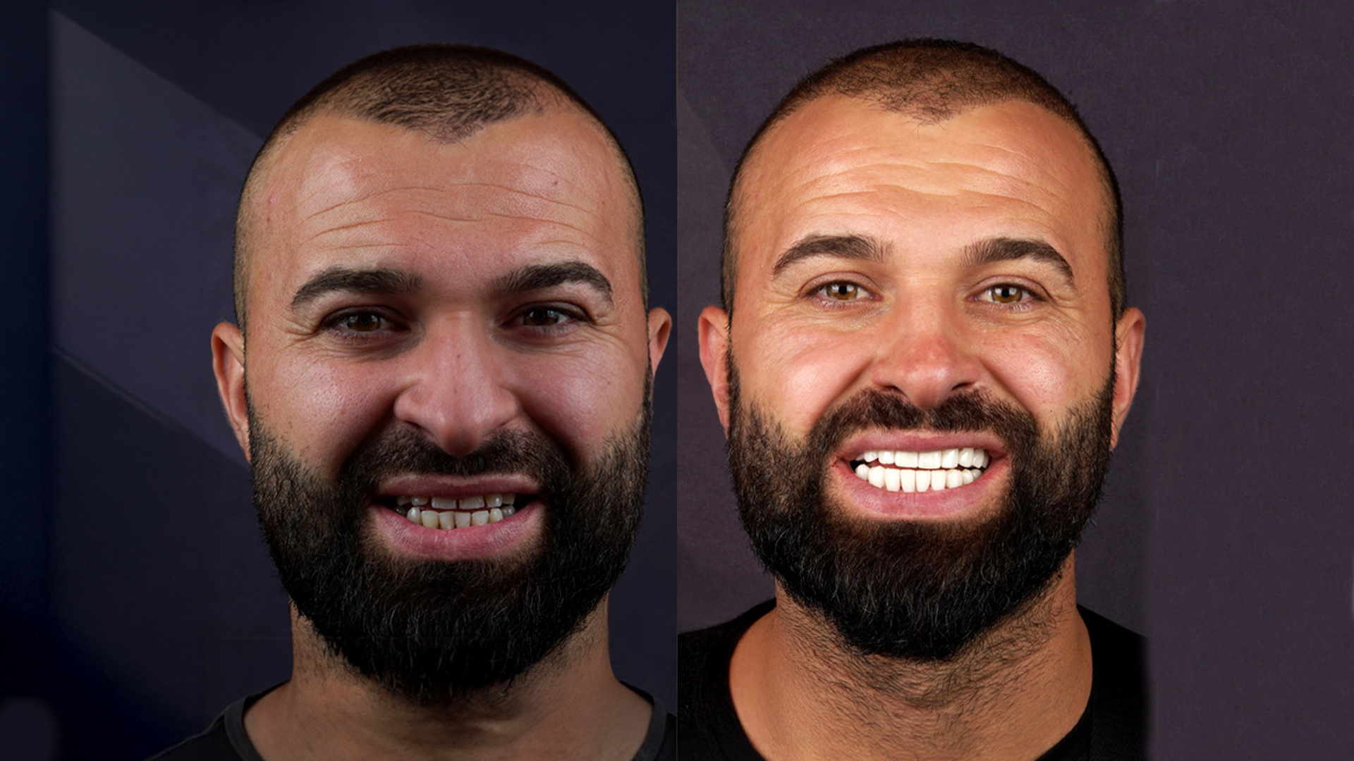 Full rehabilitation before and after